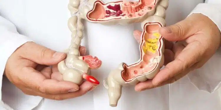 Conheça o sintoma surpreendente de câncer de intestino que pode aparecer no rosto
