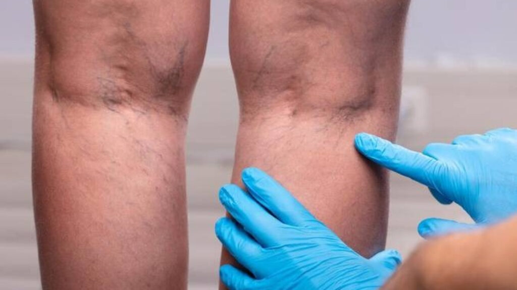 Por que os casos de trombose venosa estão aumentando sem parar?