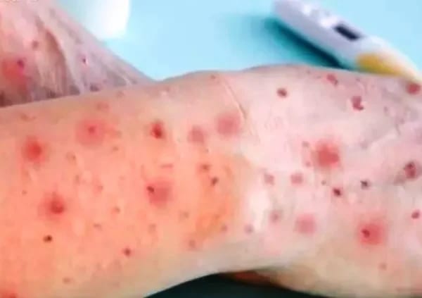 Mpox: OMS declara varíola dos macacos como uma emergência global de saúde pública