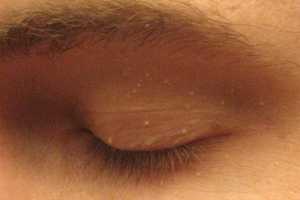Milium: o que é, por que ele aparece e como tratar?