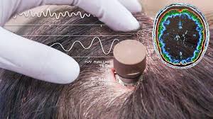 China implanta com êxito chip que restaura memória em paciente com Alzheimer