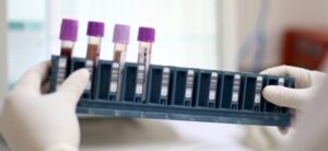 Pará já conta com pontos de coleta para exame genético de doenças raras no SUS