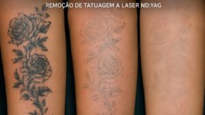 Curso mostra como atuar com remoção a laser sem investir em máquina própria